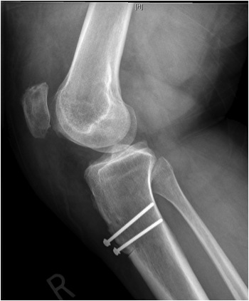 Chronic Patella Tendon Rupture Post Op Lateral